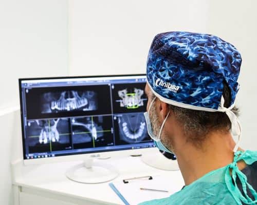 dental implants Marbella