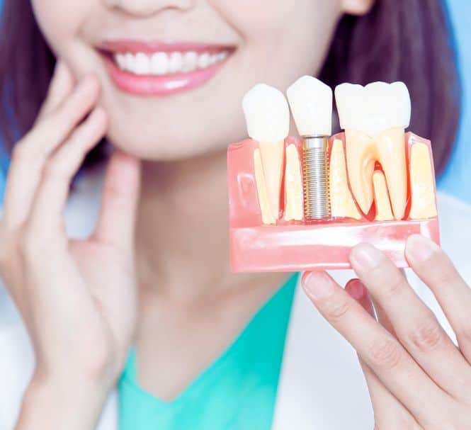 dental implants Marbella