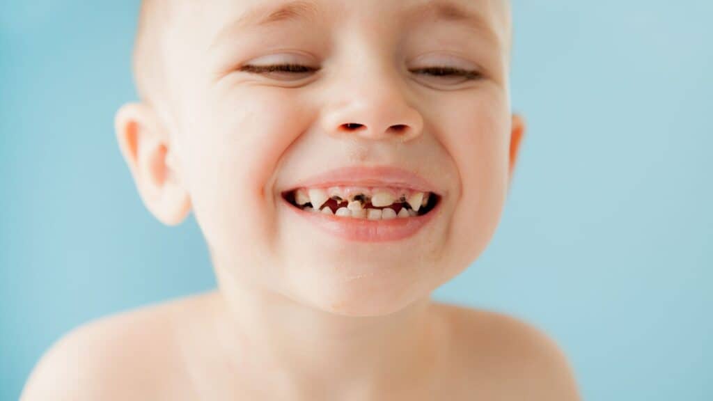 caries infantiles