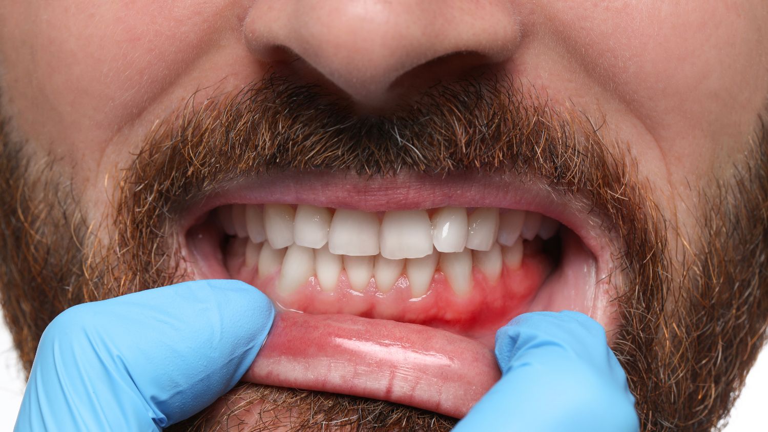 sangrado de encías al cepillarse