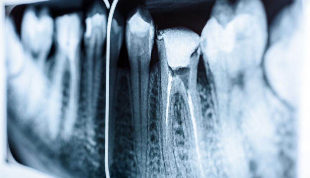 ¿Duele una endodoncia?